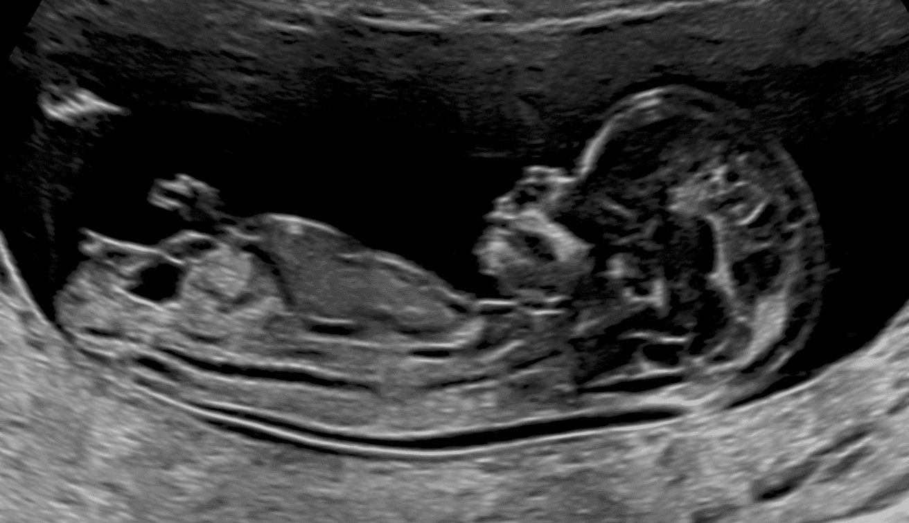 妊娠12週の精密エコー写真　超音波検査　出生前検査　出生前診断　NIPT　無認証NIPT