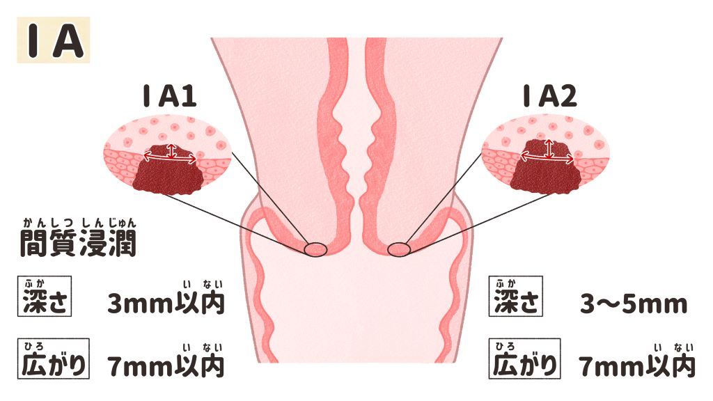 子宮頸がん