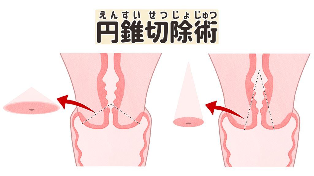 子宮頸がん 円錐切除術