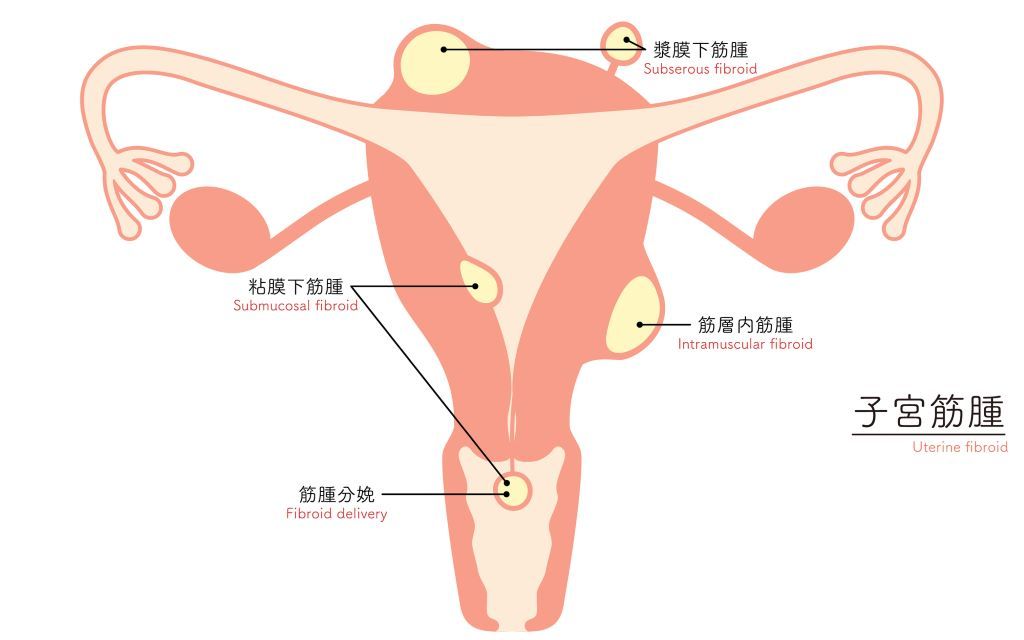 子宮筋腫 種類