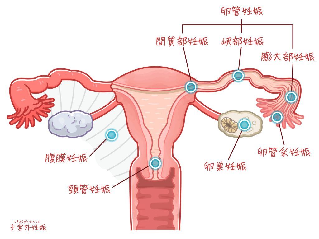 異所性妊娠　子宮外妊娠　卵管妊娠　頸管妊娠　腹腔妊娠