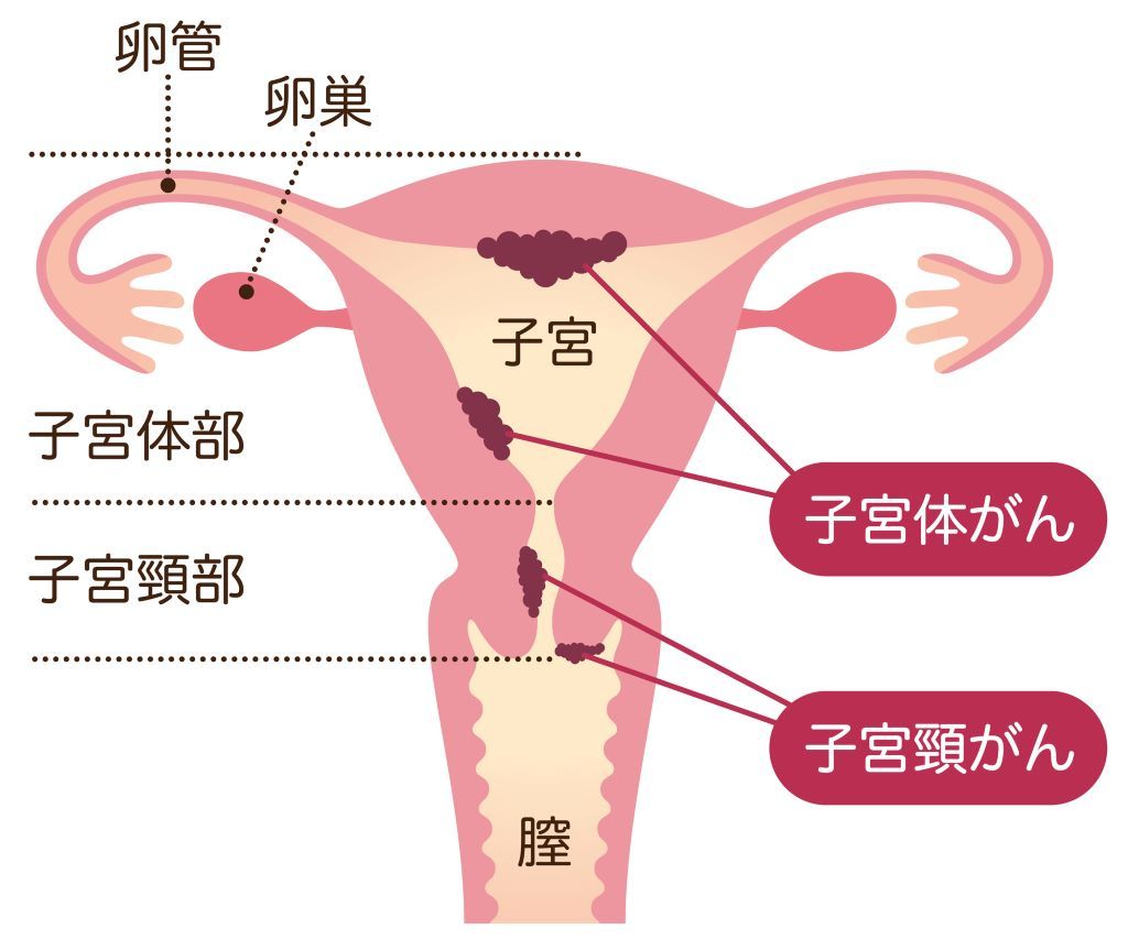 婦人科がん　子宮がん　子宮頸がん　子宮体がん