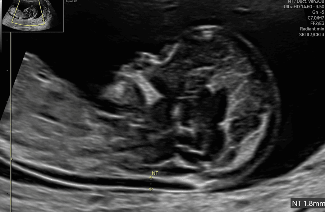 胎児エコー.png