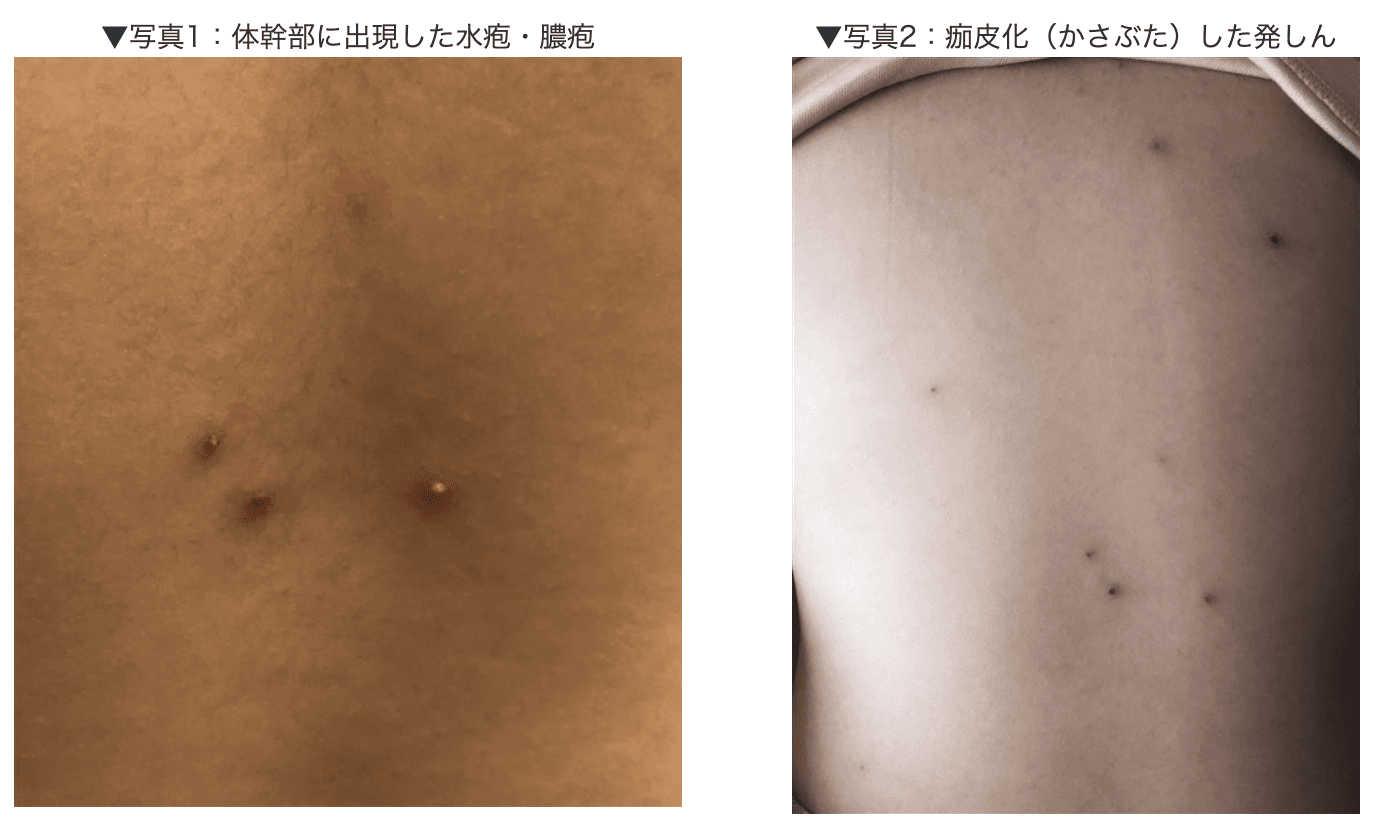 水痘の主な症状