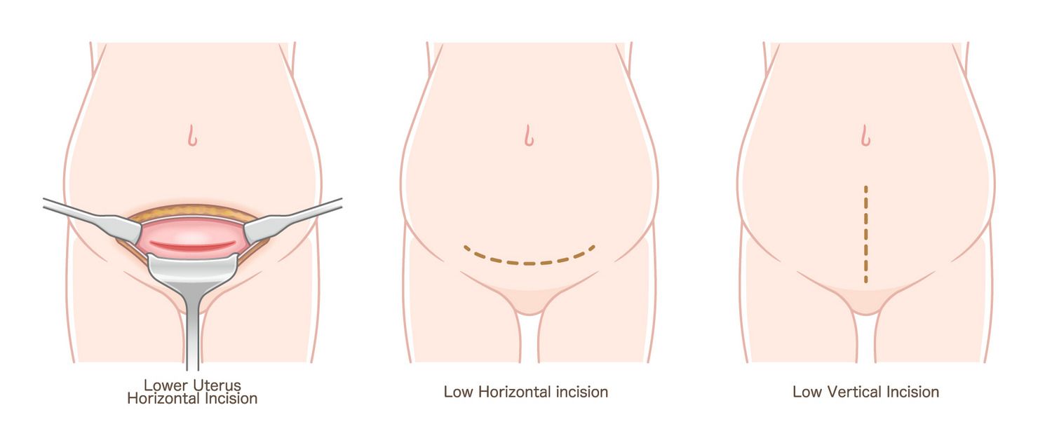 出産　分娩　帝王切開