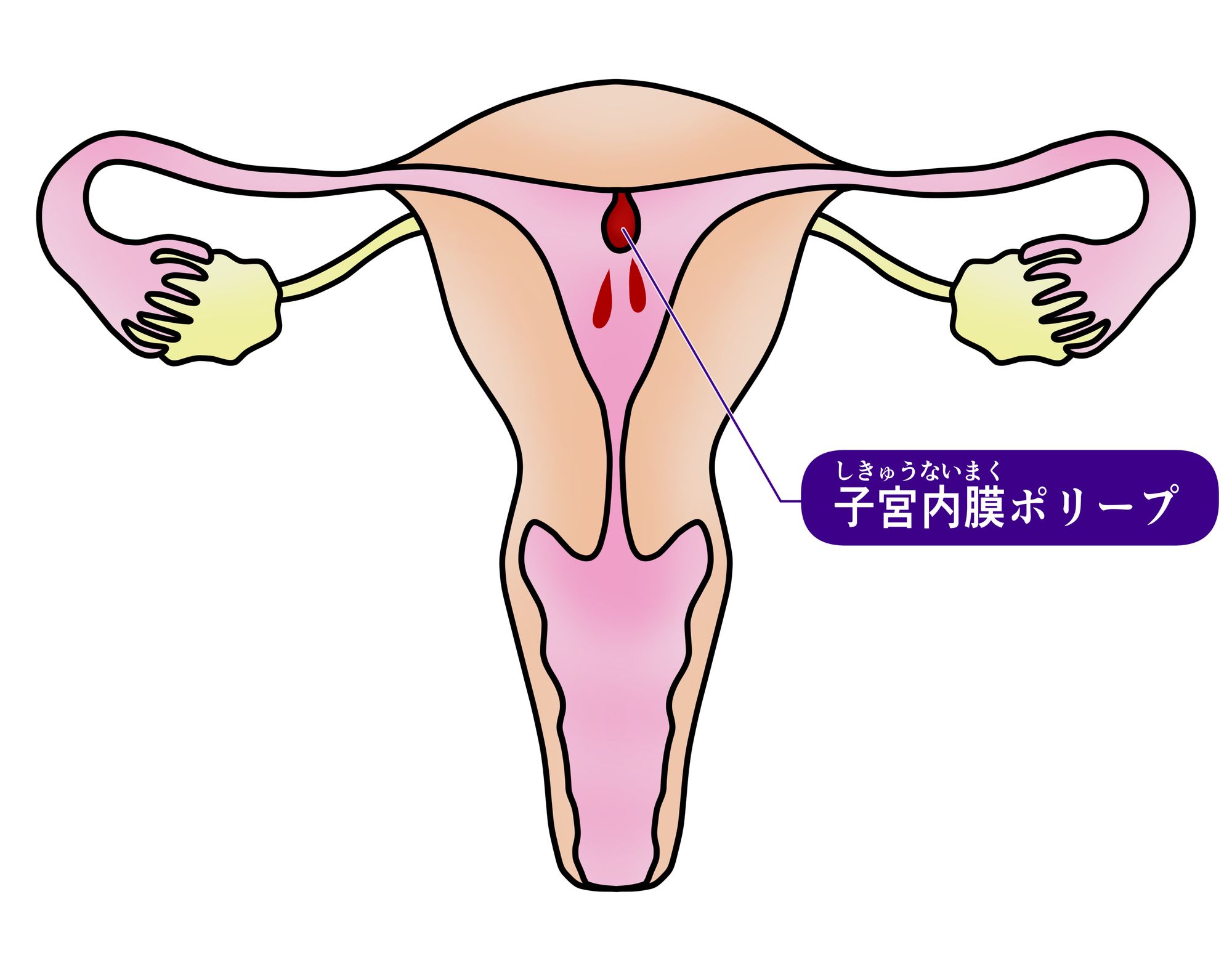 子宮内膜ポリープ