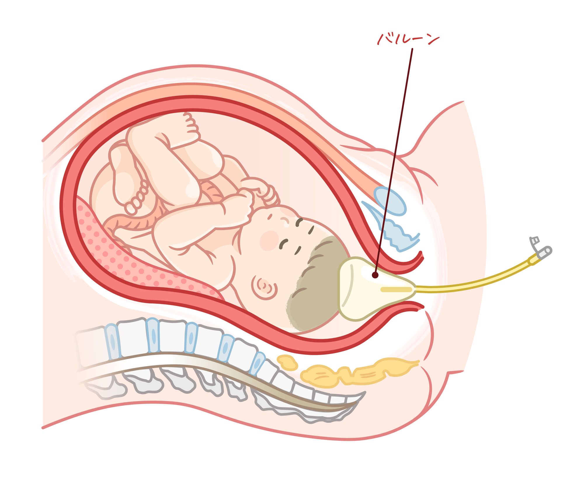 赤ちゃんの出口を柔らかく広げるバルーンのイラスト