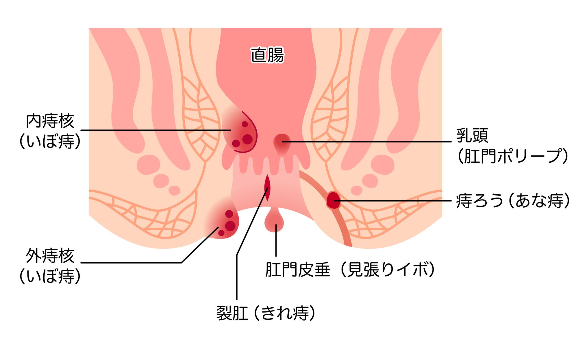 内痔核、外痔核、裂肛、肛門皮垂、乳頭、痔ろうのイラスト
