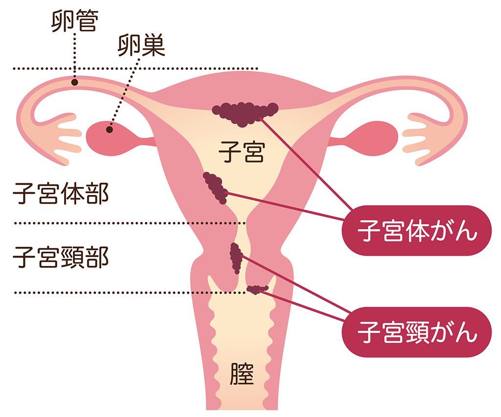 子宮 子宮体がん 子宮頸がん