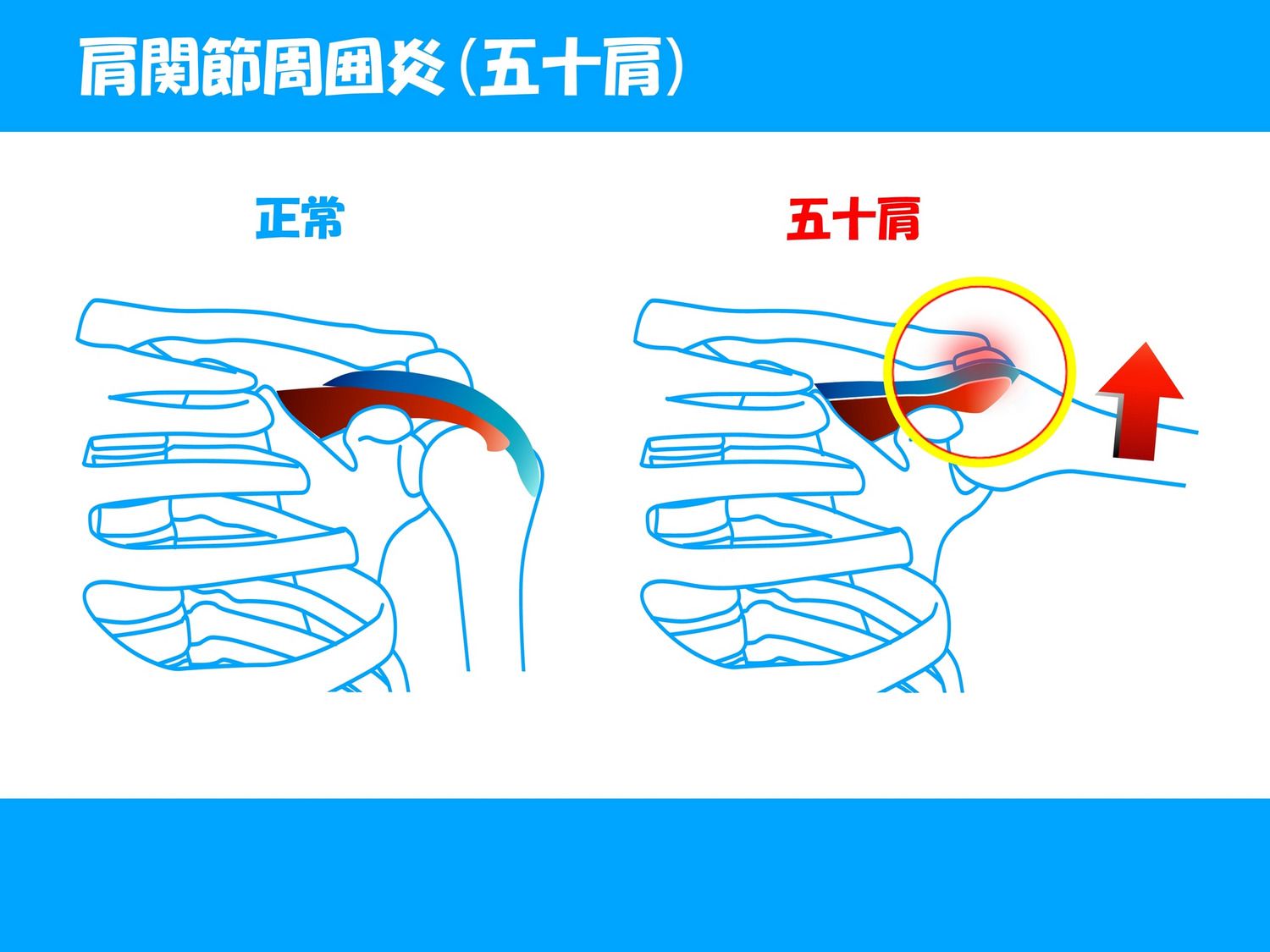 肩の痛み　五十肩　肩関節周囲炎
