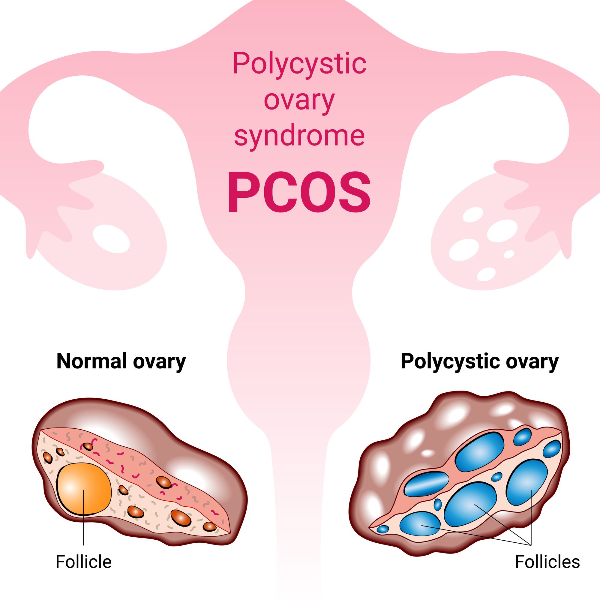 正常な卵巣とPCOSの卵巣の比較