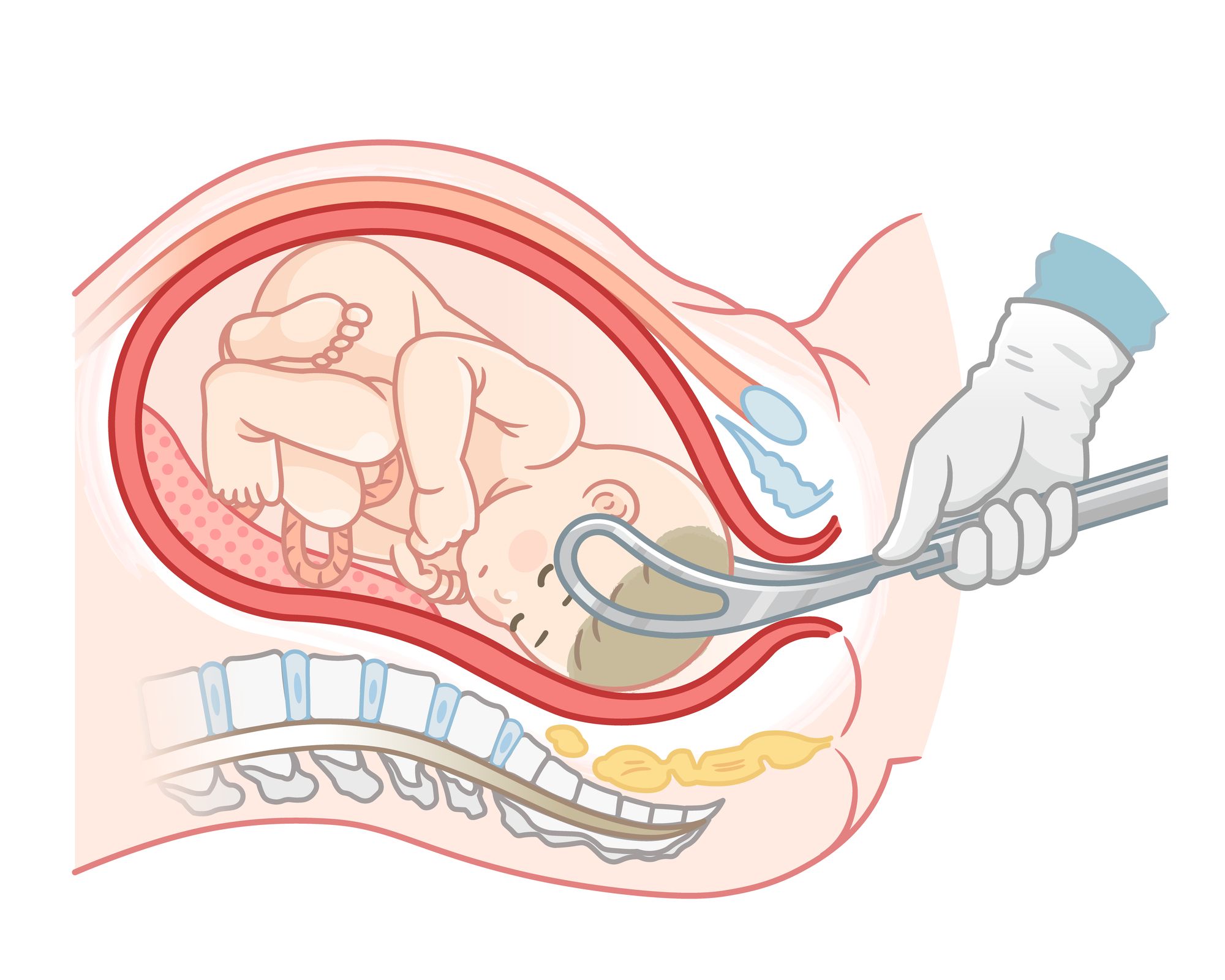 鉗子分娩のイラスト