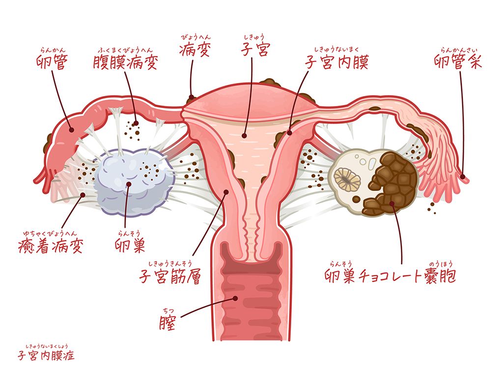 子宮内膜症
