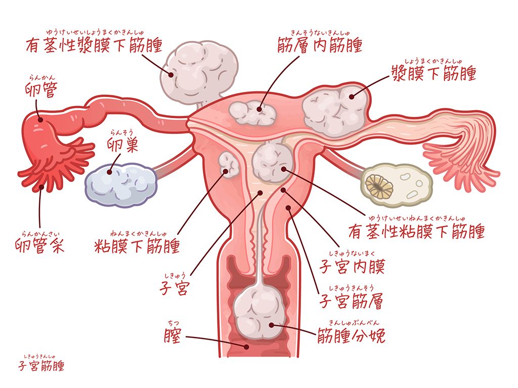 子宮筋腫