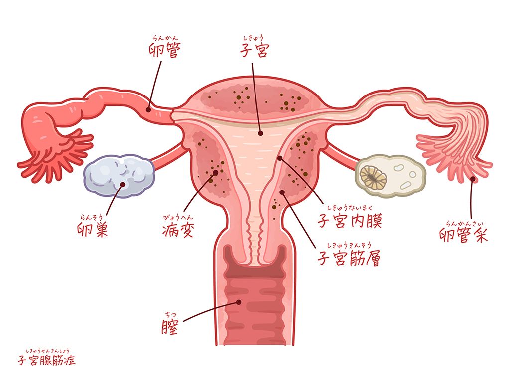 子宮腺筋症
