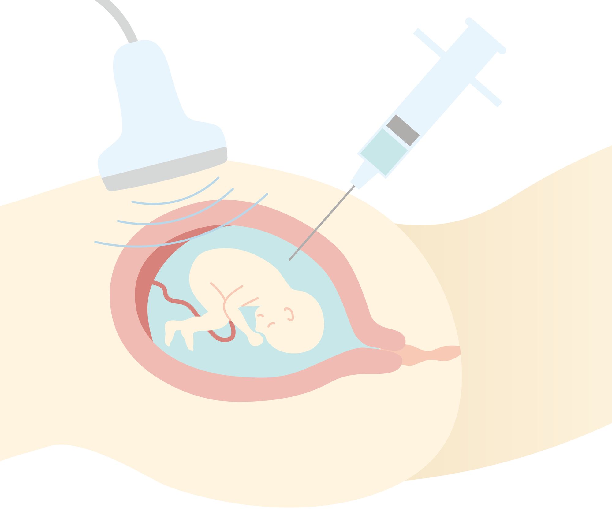 お母さんのお腹に針を刺す、羊水検査のイラスト