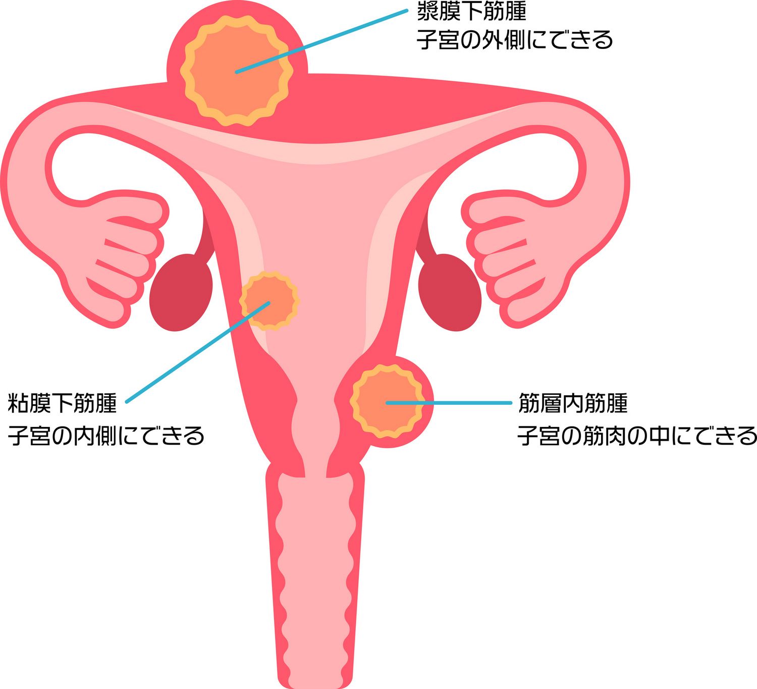 子宮筋腫　種類